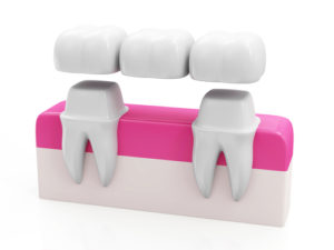 dental bridges denver co
