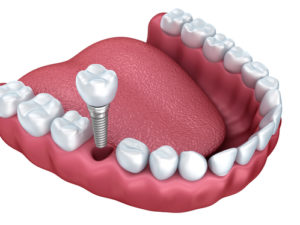 dental implants denver co